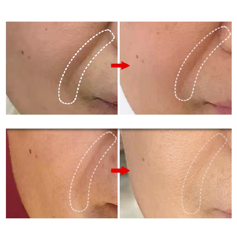 BANDĂ ANTI-RIDURI PENTRU ÎNTINS PIELEA FACIALĂ